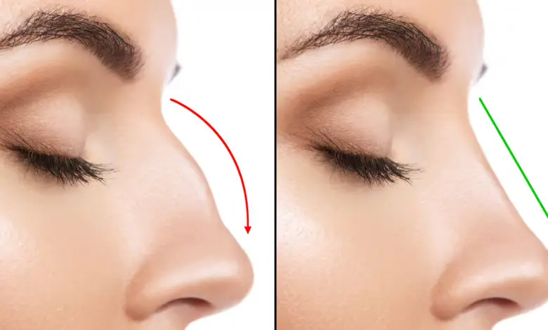 تجميل الأنف : كم تكلّفك العملية وما هي النتائج المتوقّعة ؟ - Vera Clinic