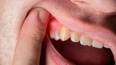 علاج التهاب اللثة